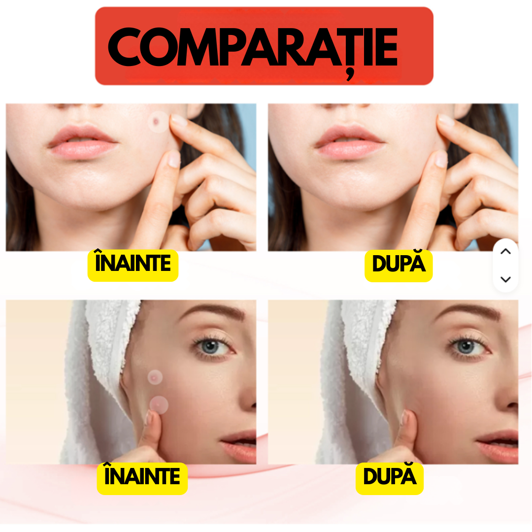 DermaClear® – Plasturi anti-negi și papiloame