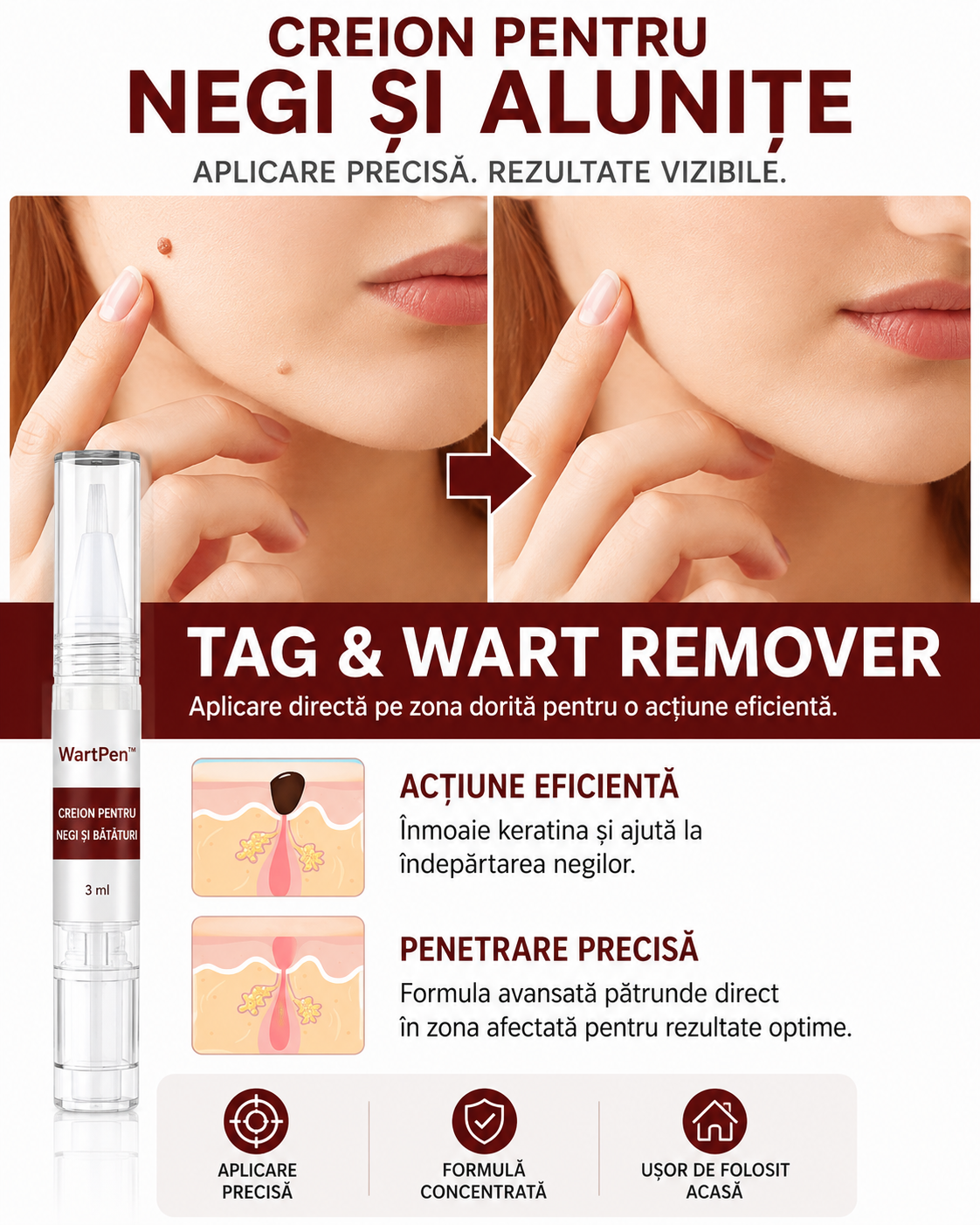 WartPen™ – Creion pentru Negi și Bătături