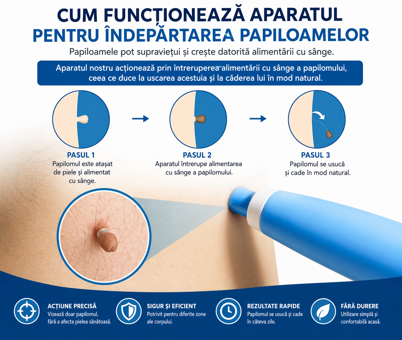 DermaFix Pro – Aparat pentru Papiloame