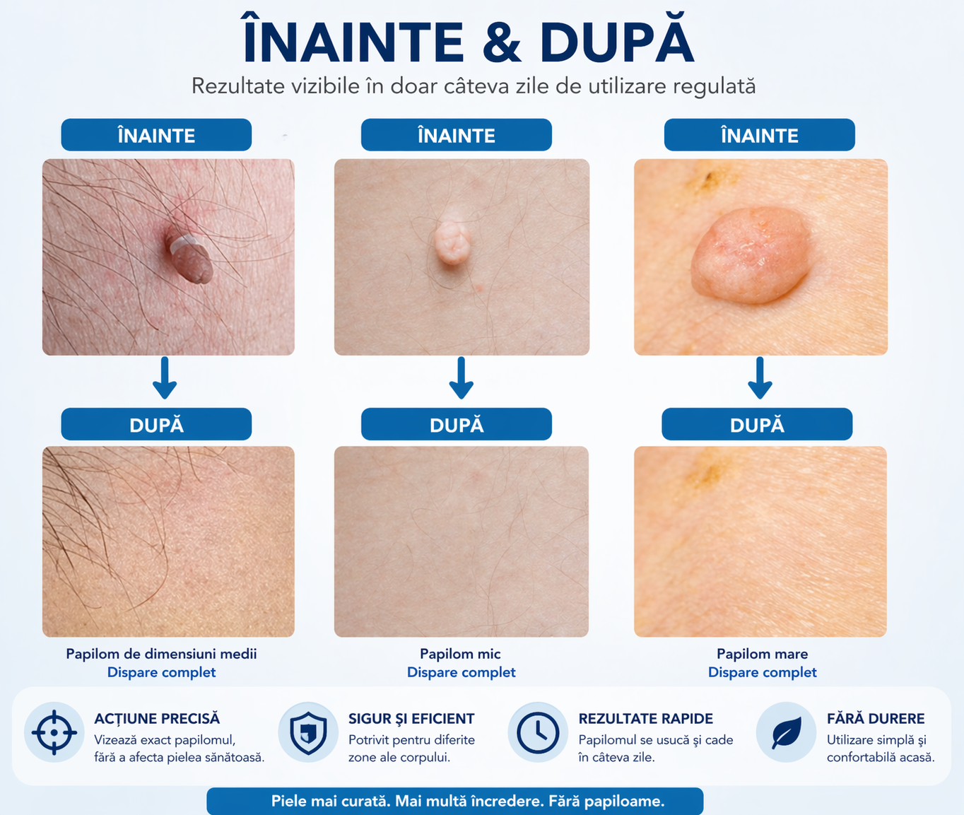 DermaFix Pro – Aparat pentru Papiloame