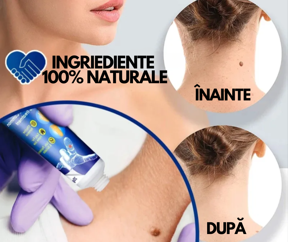 WartRemover - Crema Anti Negi