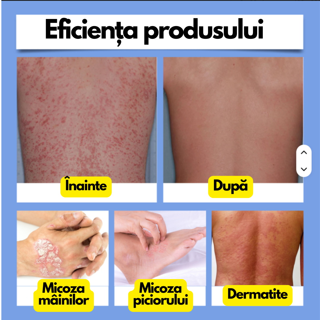 🐝 BeeCalm – Spray calmant pentru psoriazis