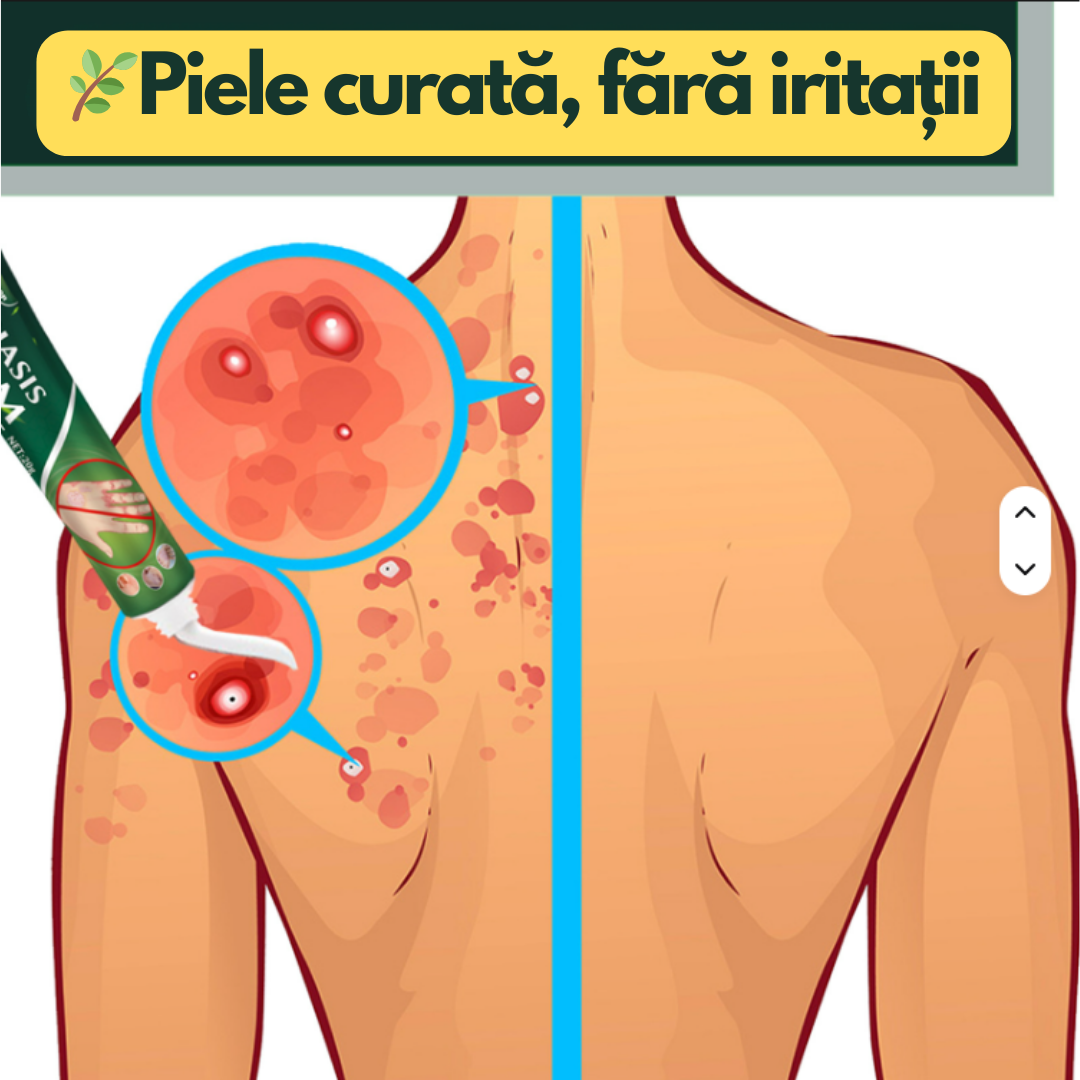 PsoriaCalm – Cremă pentru Psoriazis și Eczeme