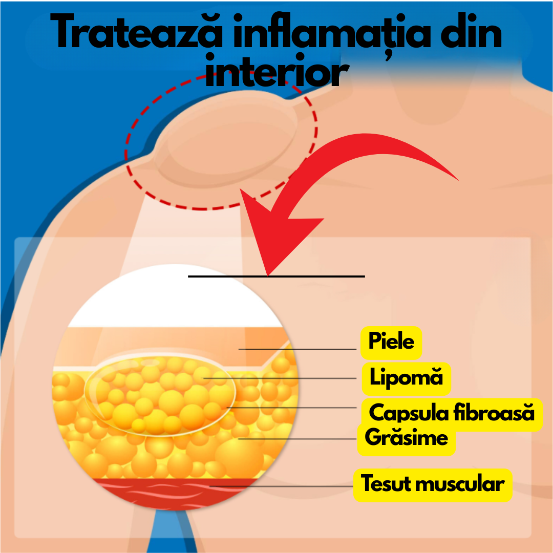 LipoStop – Cremă ANTI-LIPOAME