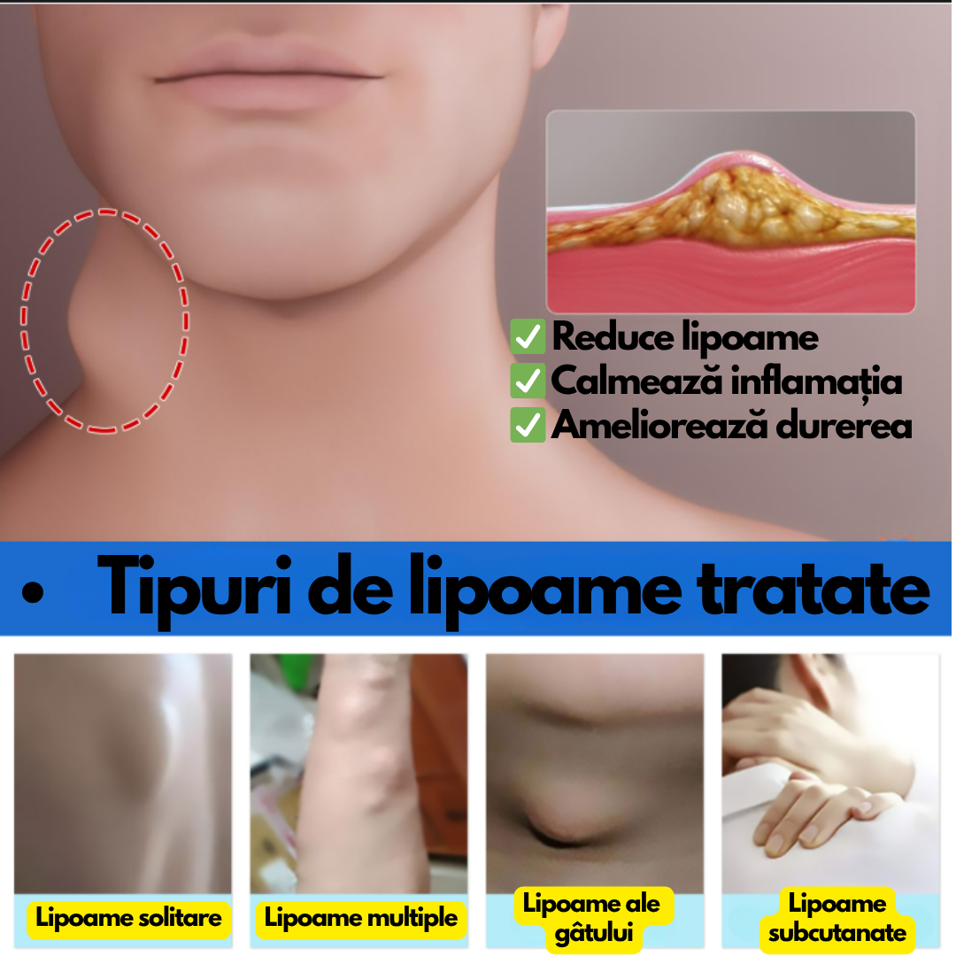 LipoStop – Cremă ANTI-LIPOAME