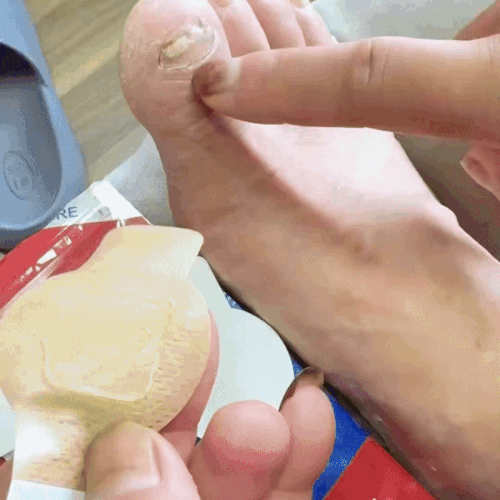 Plasturi ANTI-FUNGICI 🩹